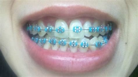 163 best Braces Colors images on Pinterest | Braces colors, Dental and ...