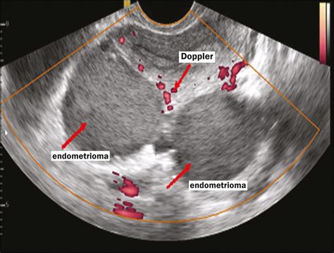 Endometrioma Ultrasound