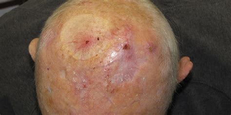 Atypical-Fibroxanthoma-of-the-Skin- AFX-Skin-Cancer-and-Reconstructive-Surgery-Center-Orange ...