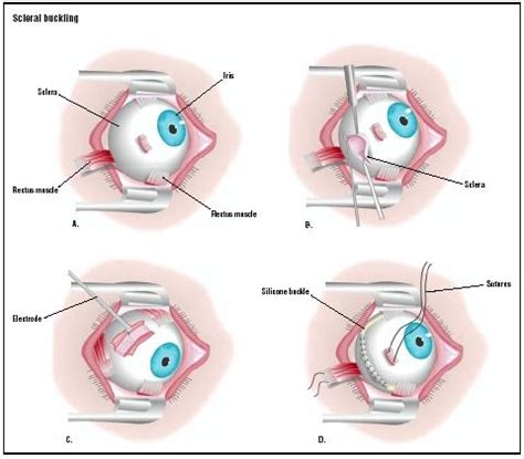 Scleral Buckling - procedure, recovery, removal, pain, complications ...