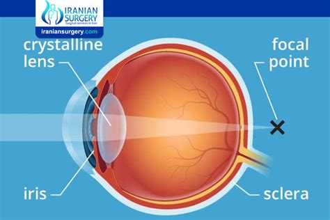 presbyopia treatment | Iranian Surgery