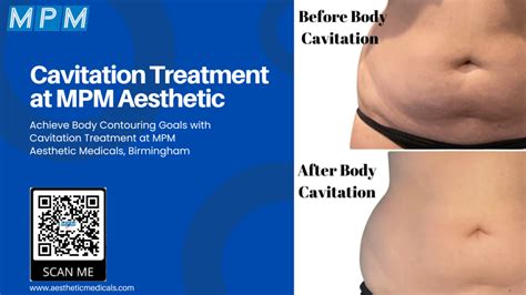 Cavitation Treatment at MPM Aesthetic Medicals, Birmingham