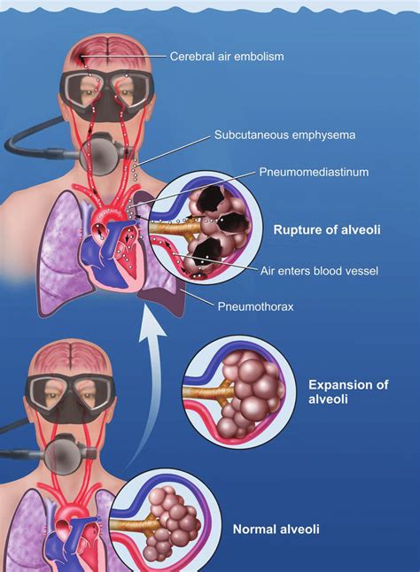 Mechanism of pulmonary barotrauma in a diver breathing compressed gas... | Download Scientific ...