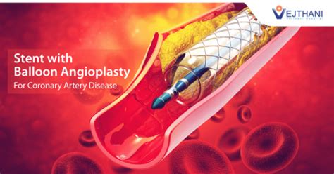Stent with Balloon Angioplasty for Heart Disease Treatment - Vejthani Hospital | JCI Accredited ...