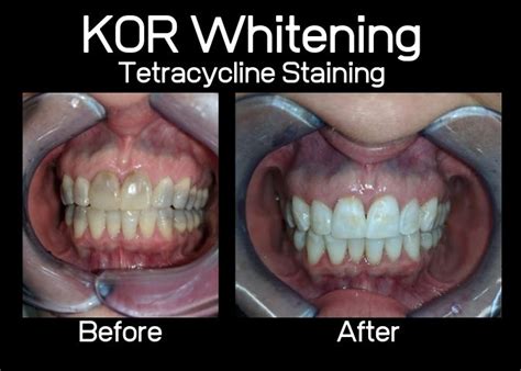 Collegeville KöR Whitening System Dentist | Advanced Dentistry