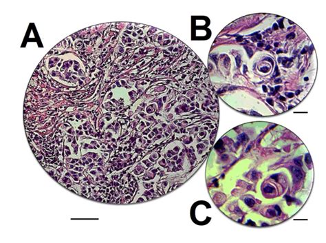 Cancers | Free Full-Text | Entosis: From Cell Biology to Clinical Cancer Pathology