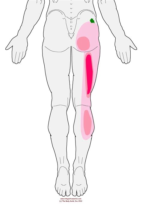 referral - gluteus minimus - posterior origin Cupping Therapy, Yoga ...