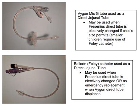 Direct (Surgically placed) Jejunostomy tube – information for parents ...