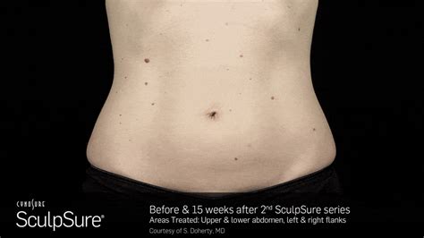 SculpSure Best Fat Removal in San Francisco.