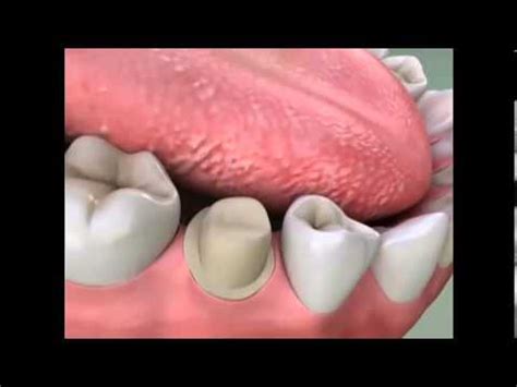 Crowns - procedure - PFM Crowns - YouTube