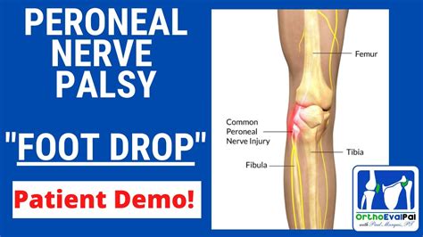 Common Peroneal Neuropathy