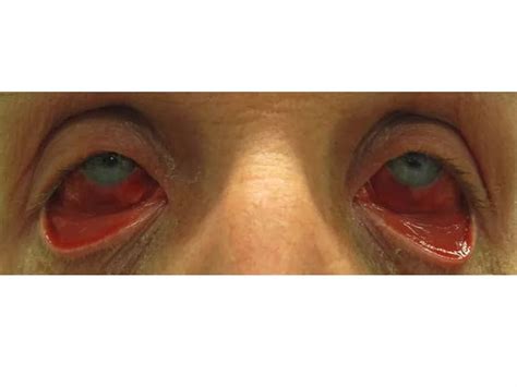 Acute Hemorrhagic Conjunctivitis (AHC) - DoveMed