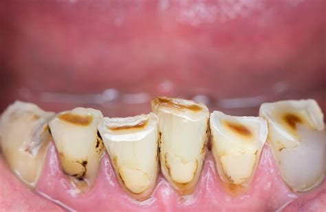 Rotten Teeth Treatment Hoppers Crossing | Connect Dental Care