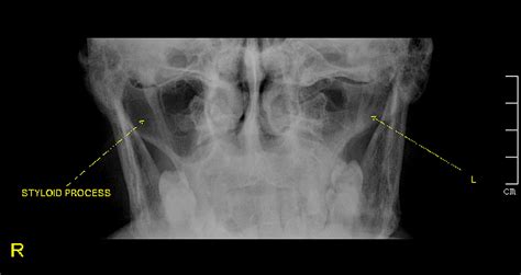 Eagle’s Syndrome Managed Successfully by Pulsed Radiofrequency Treatment | Cureus