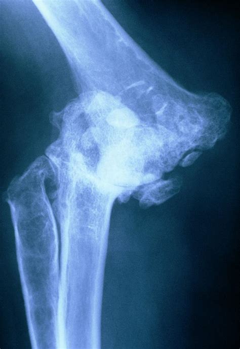 Tinted X-ray Of Elbow With Rheumatoid Arthritis. Photograph by Medical ...