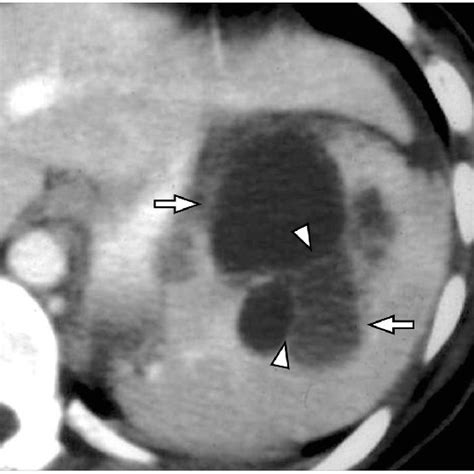 Peliosis of spleen. Contrast-enhanced CT shows multiple hypodense... | Download Scientific Diagram