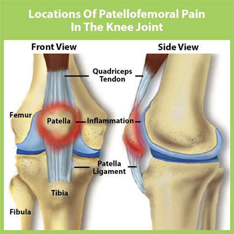 Can You Have Runner’s Knee If You’re Not A Runner? — The Knee Joint