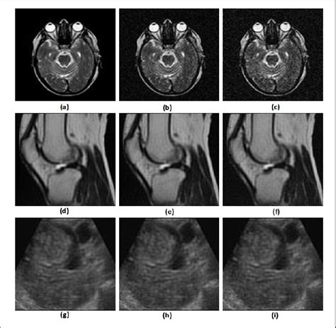 Medical images: (a) Noise-free MRI brain image, (b) Level 1 noisy MRI... | Download Scientific ...