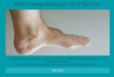 Painful Bump on Top Of Foot | Tanglewood Foot Specialists