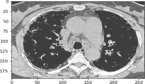 A view of CT (Computer Tomography) scan image of COVID patient ...