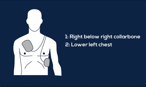 Guide to AED Pad Placement - MDPRO USA