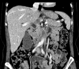 Pancreatic lesion on pancreatic protocol CT abdomen. Figure 3 ...