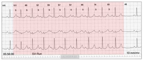 Exotic atrial ectopy part two - Resources