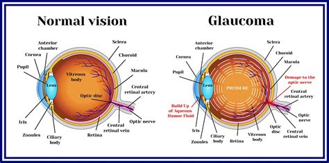 Open Angle Glaucoma Eye