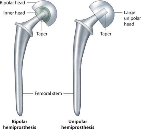 Why Partial Hip Replacements Fail and Determining when It’s Time to Covert to a Total Hip ...