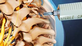 Cervical Epidural Steroid Injection Video