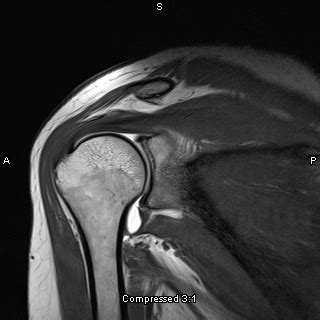 Shoulder Arthrogram MRI | Mri, Radiology, Anatomy