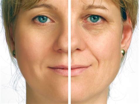 What is Laser Blepharoplasty? | Superpages