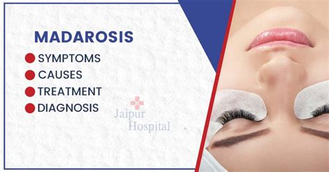 Madarosis: Symptoms, Causes, Diagnosis, and Treatment - Jaipur Hospital