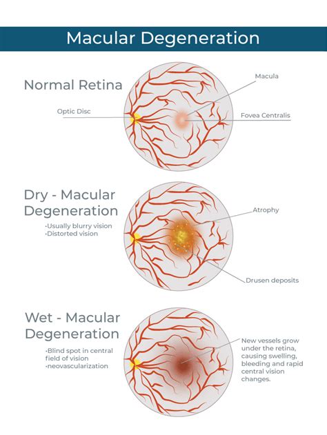 Macular Degeneration Vision