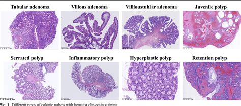 Detection rate and proximal shift tendency of adenomas and serrated ...