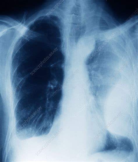 Pleurisy, X-ray - Stock Image - M240/0652 - Science Photo Library