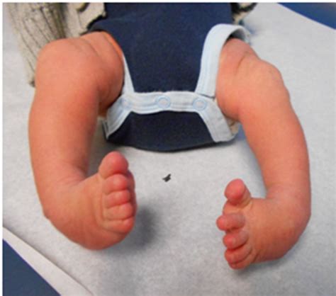 Club Foot(Congenital talipes equinovarus) - The Nepali Doctor