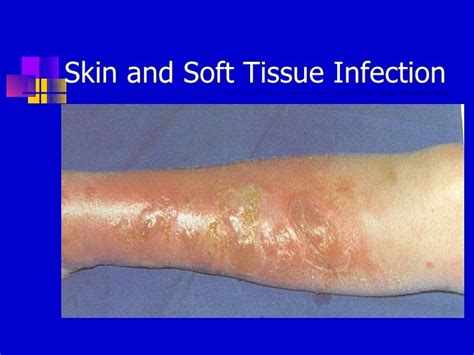 Skin And Soft Tissue Infections