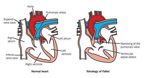 Tetralogy of Fallot