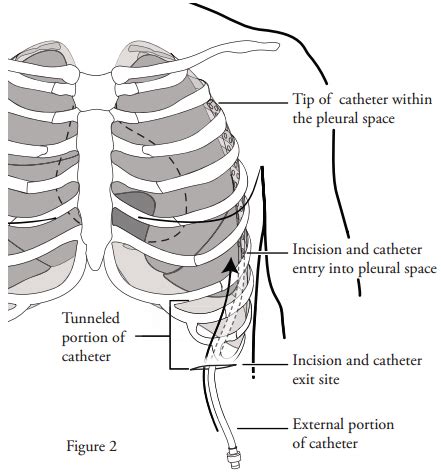 Caring for Your Pleurx Drainage Catheter - Interventional Pulmonology | Memorial Sloan Kettering ...