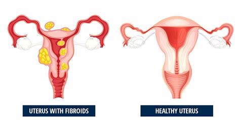 Best Treatment For Uterine Fibroids - Unique Interventional