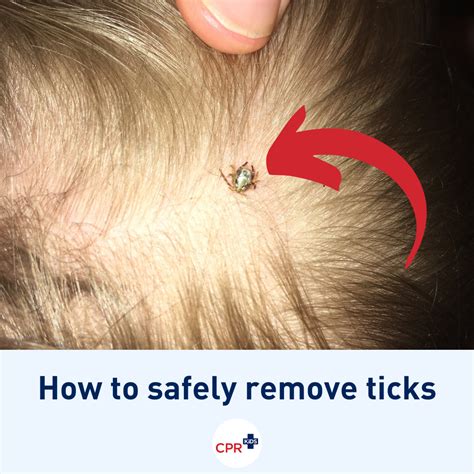 Tick Removal From Humans