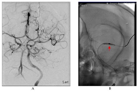 Digital subtraction angiography (DSA) images in the process of... | Download Scientific Diagram