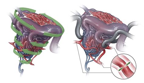 Nuances in AVM Resection | The Neurosurgical Atlas