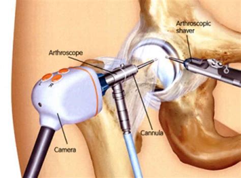 Hip Arthroscopy - UBMD Orthopaedics & Sports Medicine Doctors – Buffalo ...