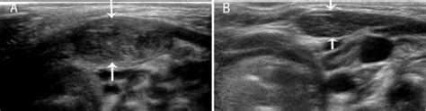 A. Cross-section of the sternocleidomastoid muscle (SCM) in a patient... | Download Scientific ...