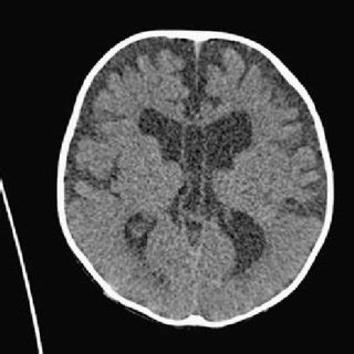 (PDF) Cavum velum interpositum, cavum septum pellucidum, and cavum ...