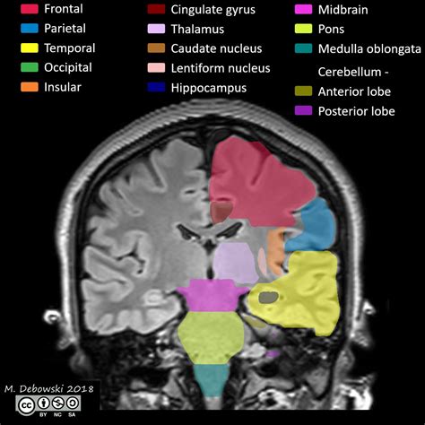 Mri Brain Axial Labelled at Jason Stewart blog