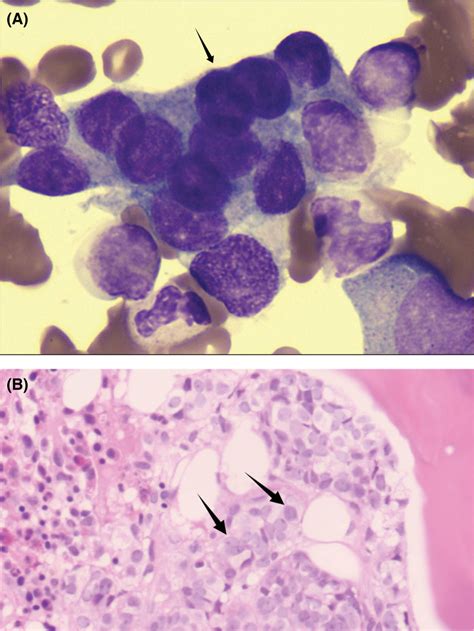 An example of the bone marrow aspiration smear and trephine biopsy... | Download Scientific Diagram