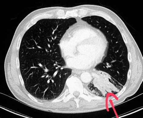 Thorax Ct Scan